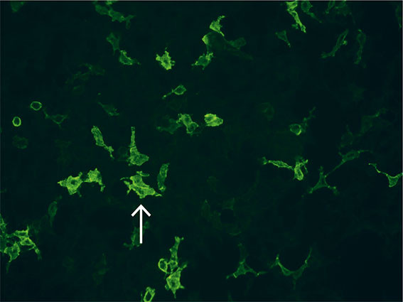 Figur 1 Indirekte immunfluorescens med Caspr1-transfekterte celler (pil) som reagerer med serum fra en pasient med Caspr1…