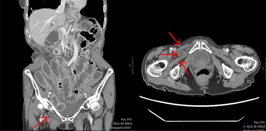 Figur 1 CT abdomen med intravenøs kontrast (aksialt og koronalt plan) fjerde dag etter første innleggelse viste dilaterte…