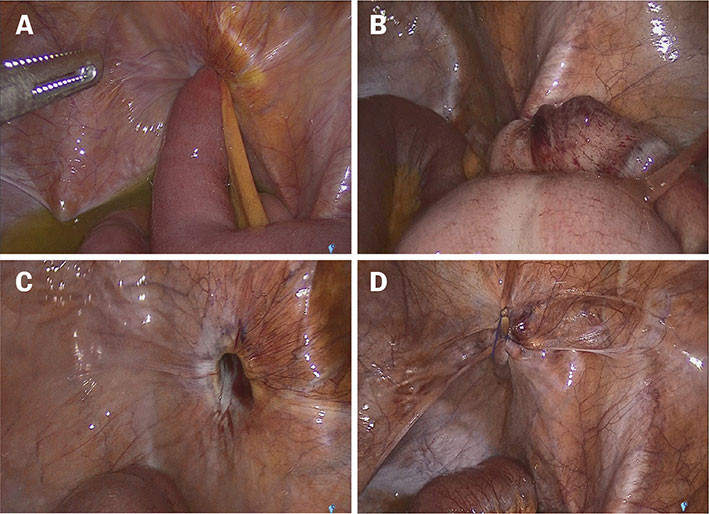 Figur 2a–d Peroperative bilder fra bukhulen med (a) inneklemt tynntarmsslynge i obturatorkanalen, (b) reponert og viabelt…