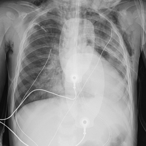 Figure 2 X-ray taken after intubation and chest drains on both sides. There was no pneumothorax, but increased opacity…