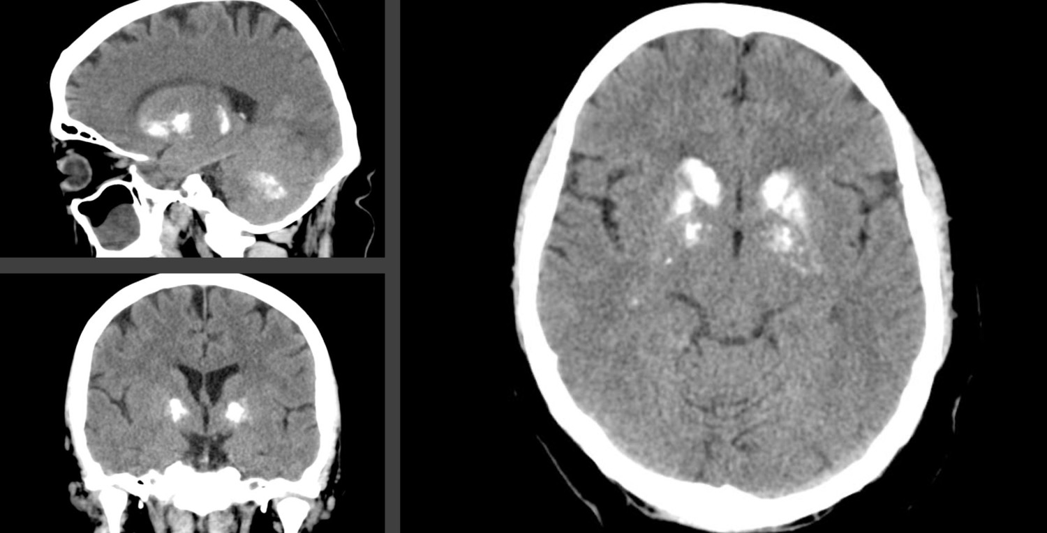 Figur 1 Utvalgte snitt fra 3D-computertomografi av hodet og hjernen til en person diagnostisert med Fahrs sykdom/primær…