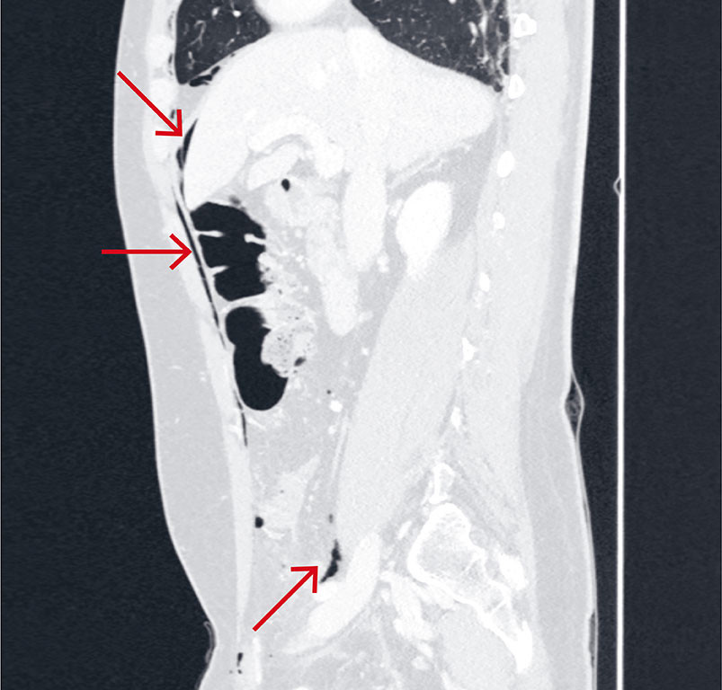 Figur 2 CT abdomen (sagittal reformatering) med intravenøs kontrast i lungevindu viste postoperative forandringer i venstre…
