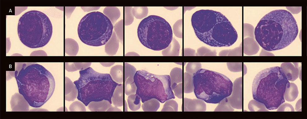 Figure 1 Examples of plasma cells (a) and reactive lymphocytes (b) in the patient's peripheral blood smear.