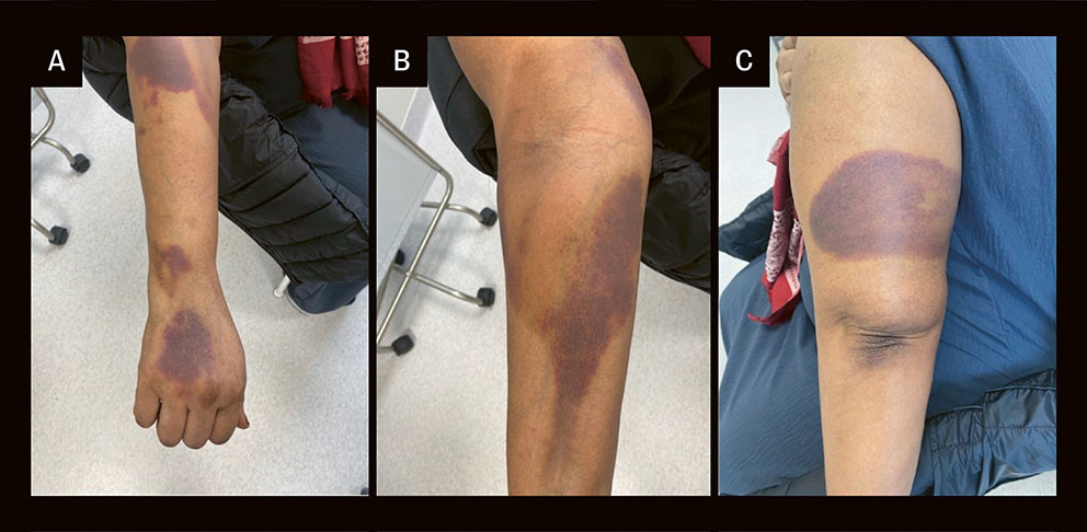 Figure 2 Cutaneous bleeding