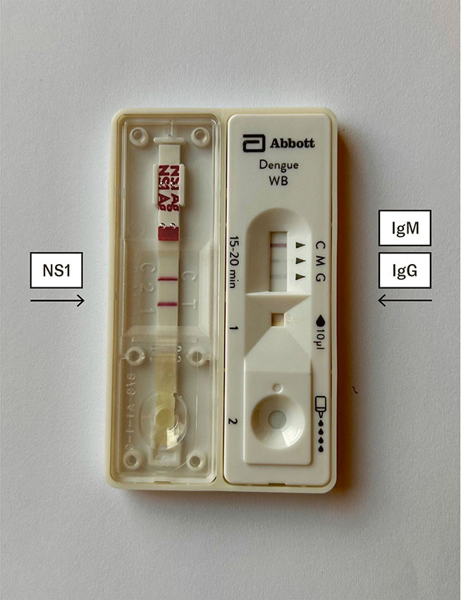 Figure 4 Positive immunochromatographic rapid test for viral antigen (NS1), IgM and IgG in the patient.