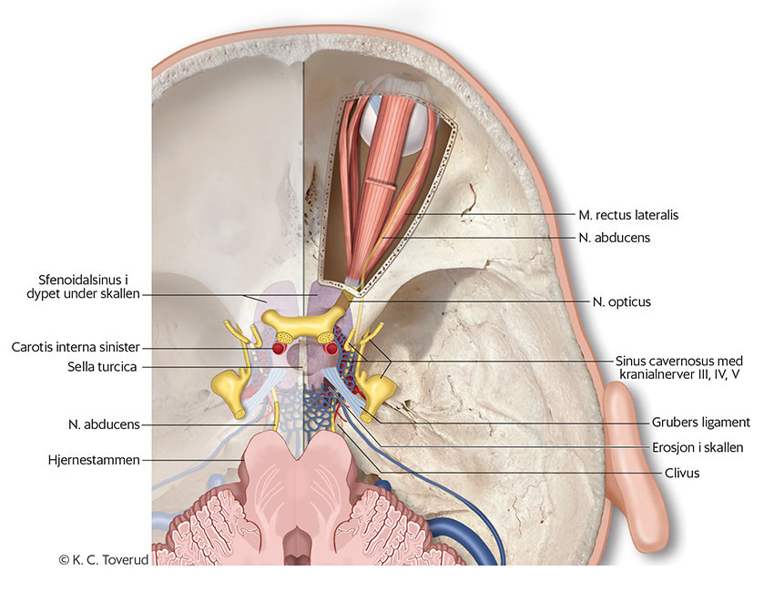 Figur 4 Anatomiske forhold omkring nervus abducens. P&aring; venstre side av illustrasjonen ses skallebasis dekket av dura&hellip;