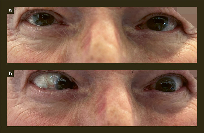 Figure 1 The images show the patient with left-sided abducens paresis and esotropic strabismus. When the patient looks&hellip;