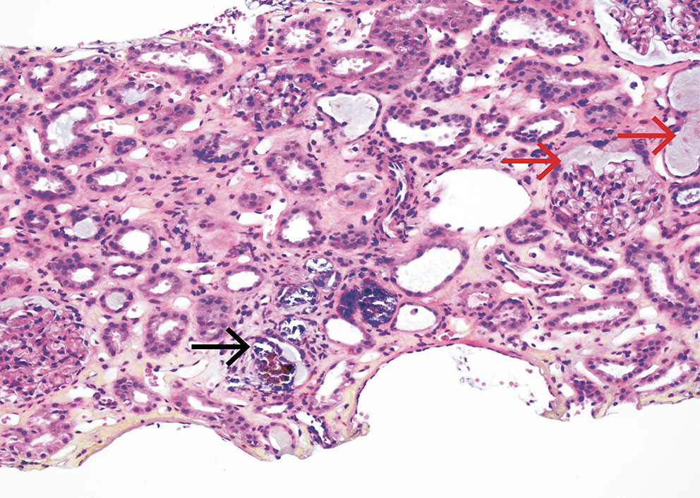 Figur 1 HES-farget nyrebiopsi viser intraluminale kalsiumfosfatavleiringer, markert med sort pil. Legg merke til gr&aring;lig&hellip;