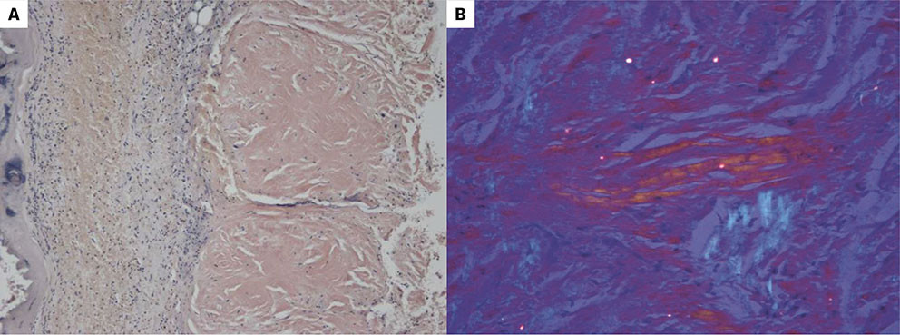 Figur 2 a) Kongor&oslash;dtfarget tumorsnitt (20&times; forst&oslash;rrelse) som viser hjertemuskel med kondenserte eosinofile cytoplasmatiske&hellip;