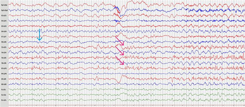 Figur 1 EEG-utsnitt fra dag 1 hos pasient med status epilepticus. Diffus polymorf langsom aktivitet og fokal interiktal&hellip;