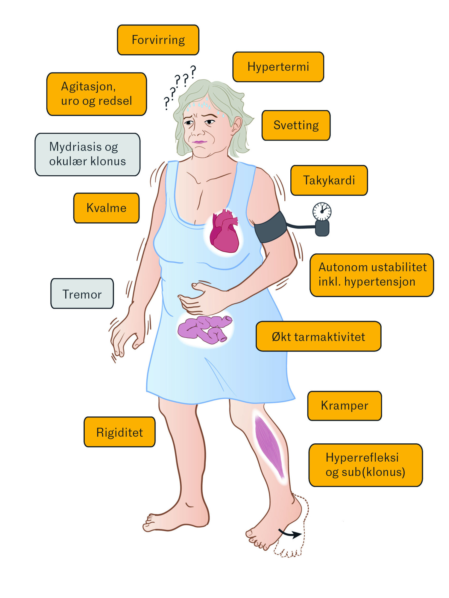 Figur 2 Typiske symptomer ved serotonergt syndrom, med pasientens symptomer p&aring; oransje bakgrunn (7&ndash;10). Illustrasjon:&hellip;
