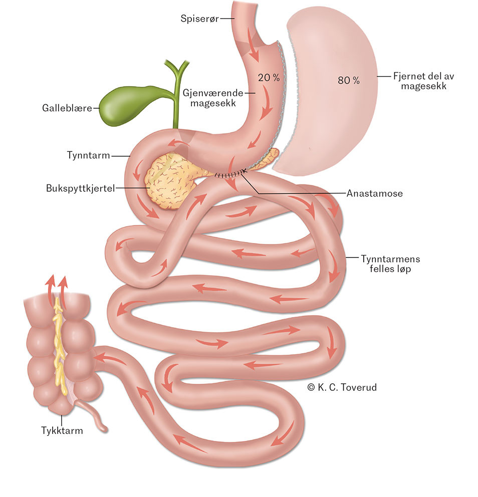 Figur 1 Ved SASI-kirurgi (single anastomosis sleeve ileal bypass) fjernes ca. 80&nbsp;% av magesekken og det lages en anastomose&hellip;