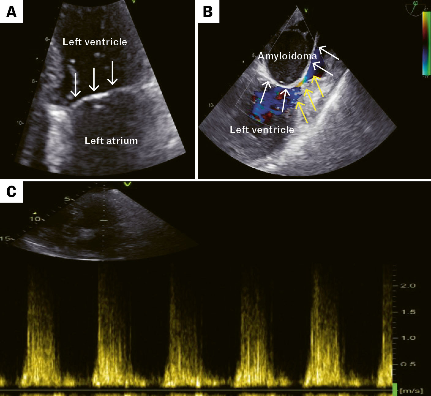 Figure 1 Echocardiography. a) Transthoracic echocardiographic image showing a bridge-like structure (white arrows) near the&hellip;