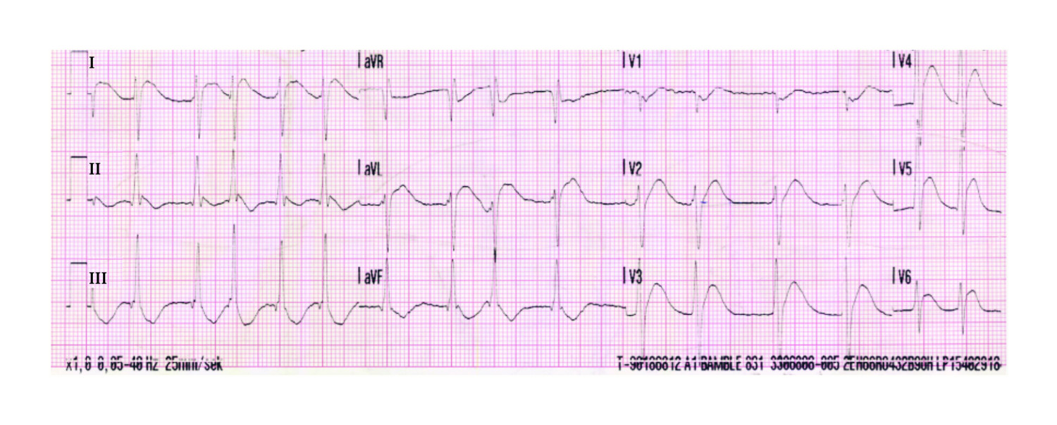 Figur 1 EKG registrert prehospitalt (ambulanse) umiddelbart etter gjenopprettet spontansirkulasjon viste atrieflimmer med&hellip;