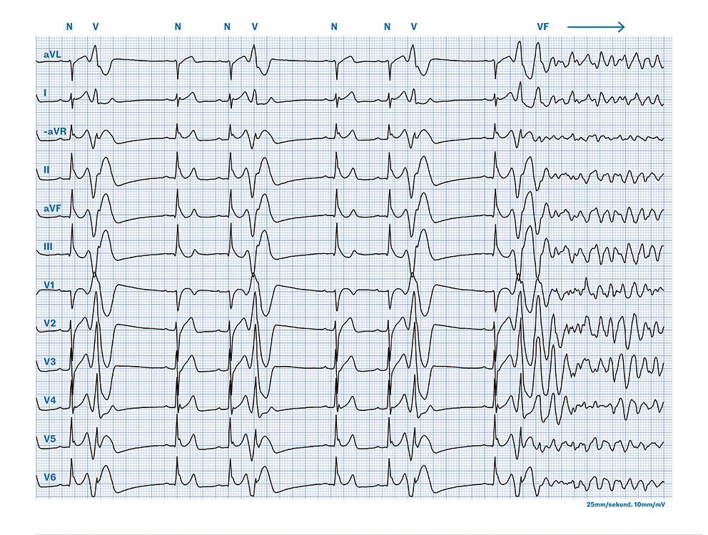 Figur 2 EKG tatt umiddelbart f&oslash;r hjertestans (Cabrera oppsett, papirhastighet 25&nbsp;mm/sek). Sinushjerterytme, frekvens 65 slag&hellip;