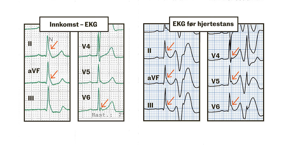 Figur 3 J-b&oslash;lger markert med piler. Venstre bildehalvdel viser inferiore og laterale avledninger fra innkomst-EKG, h&oslash;yre&hellip;