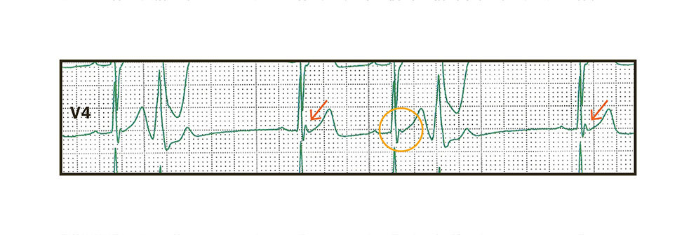 Figur 4 Rytmestripe avledning V4. QRS-kompleks med forutg&aring;ende postekstrasystolisk pause, og dermed forlenget RR-intervall,&hellip;