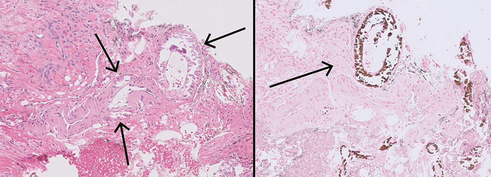 Figur 1 Biopsi av dermis og subcutis fremstilt med hematoksylin-eosin-farging (20&times; forst&oslash;rrelse) til venstre og von Kossa&hellip;