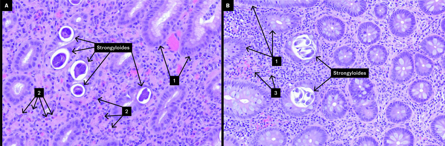 Figure 1 Biopsies (HES stained) from (A) stomach and (B) colonic mucosa demonstrated parasites in crypts (Strongyloides) and&hellip;