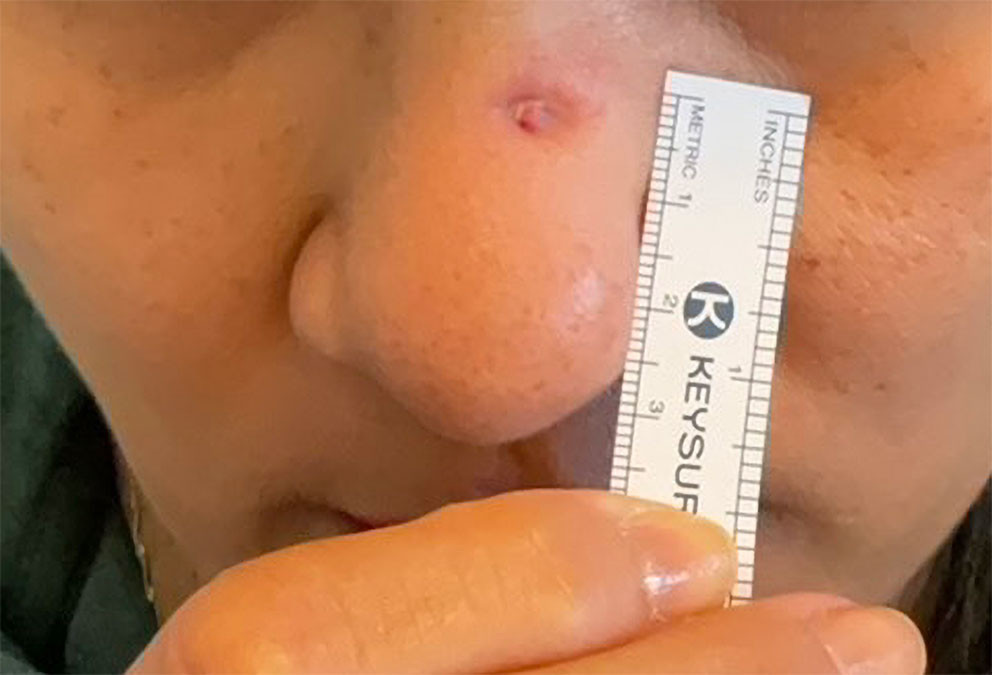 Figur 1 Pasient med silikonimplantat i nesen og kronisk infeksjon i hud.