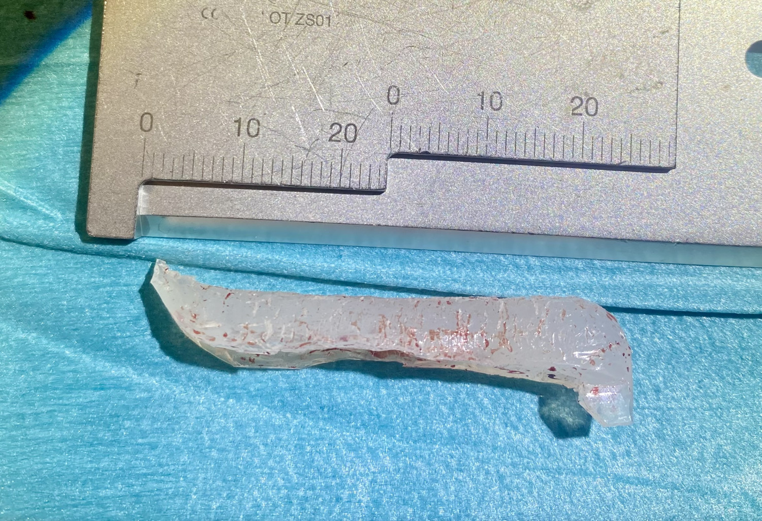 Figur 2 Silikonimplantat fjernet fra pasientens nese.