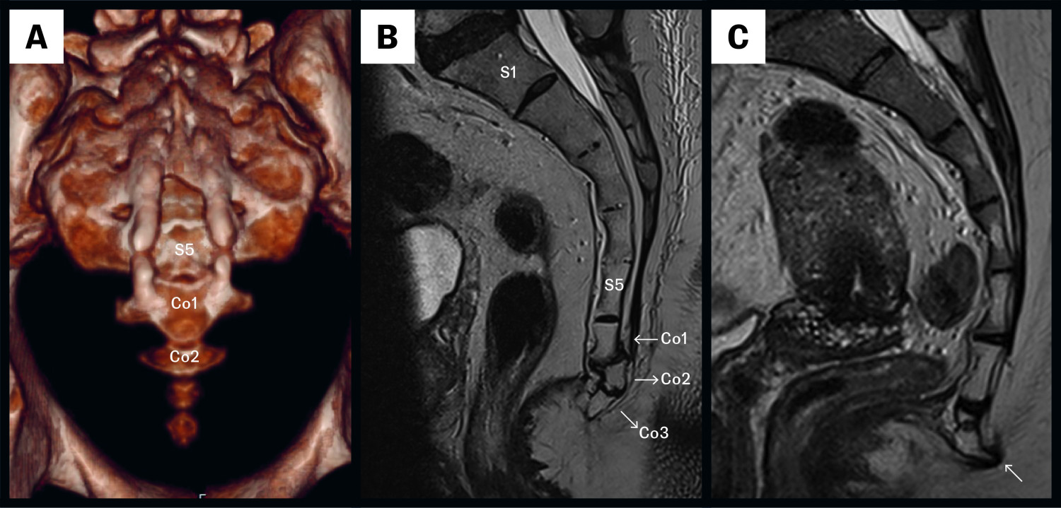 Figure 1 a) Normal findings with four coccygeal vertebrae displayed on a CT scan (anterior view with 3D reconstruction)&hellip;