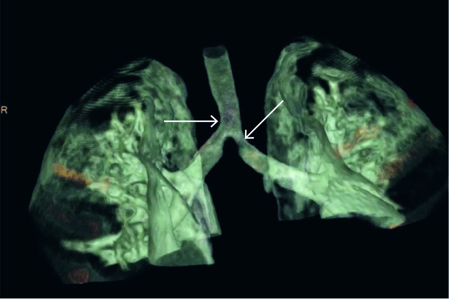 Figur 1 Eksempel p&aring; 4D-CT volumbilde i frontplan. Pilene peker p&aring; ekstern kompresjon av trakea og venstre hovedbronkus, som&hellip;
