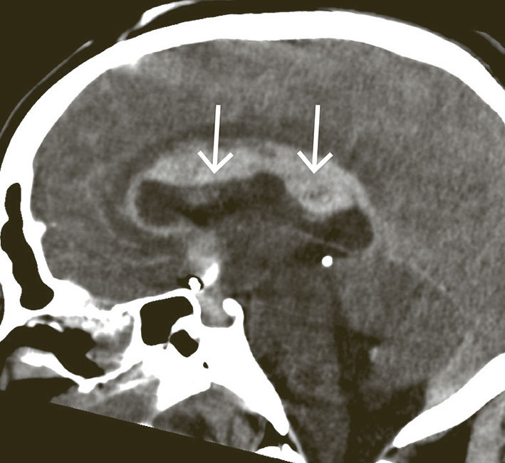 Figur 2 CT caput i sagittalplan etter aneurismeruptur under behandling, med bl&oslash;dning langs corpus callosum og gyrus cinguli &hellip;