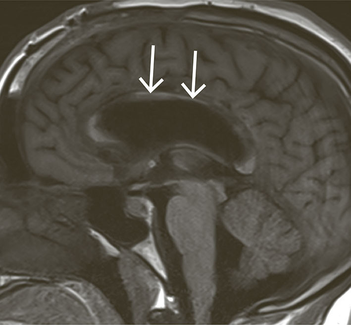 Figur 3 MR caput i sagittalplan viser omfattende substanstap i corpus callosum og gyrus cinguli (piler) som sekvele.