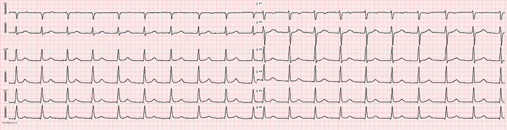 Figur 1 EKG hos fastlegen viste smalkomplekset regelmessig takykardi med ventrikkelfrekvens p&aring; 105/min, uten tydelige P&hellip;