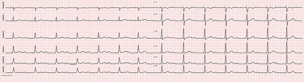 Figur 2 EKG etter betablokker. Hjertefrekvensen ble dermed redusert og hjerterytmen kunne identifiseres som et&hellip;