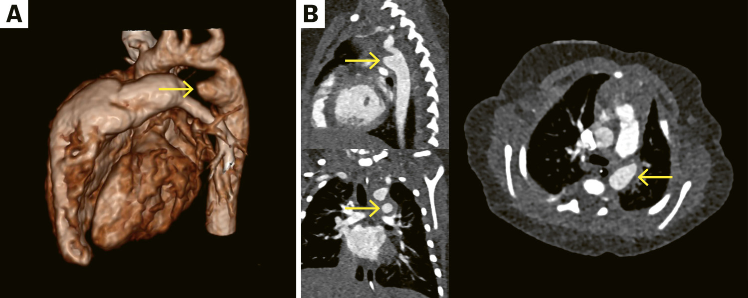 Figur 1 CT-angiografi som viser aneurisme i ductus arteriosus (piler), med 3D-volumrendering (a) og multiplan&aelig;re&hellip;