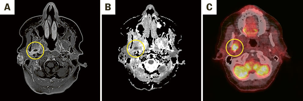 Figur 1 A) Abscess i mastikatorspatiet p&aring; h&oslash;yre side. Aksial T1-vektet bilde med fat saturation, og kontrastv&aelig;ske like under&hellip;