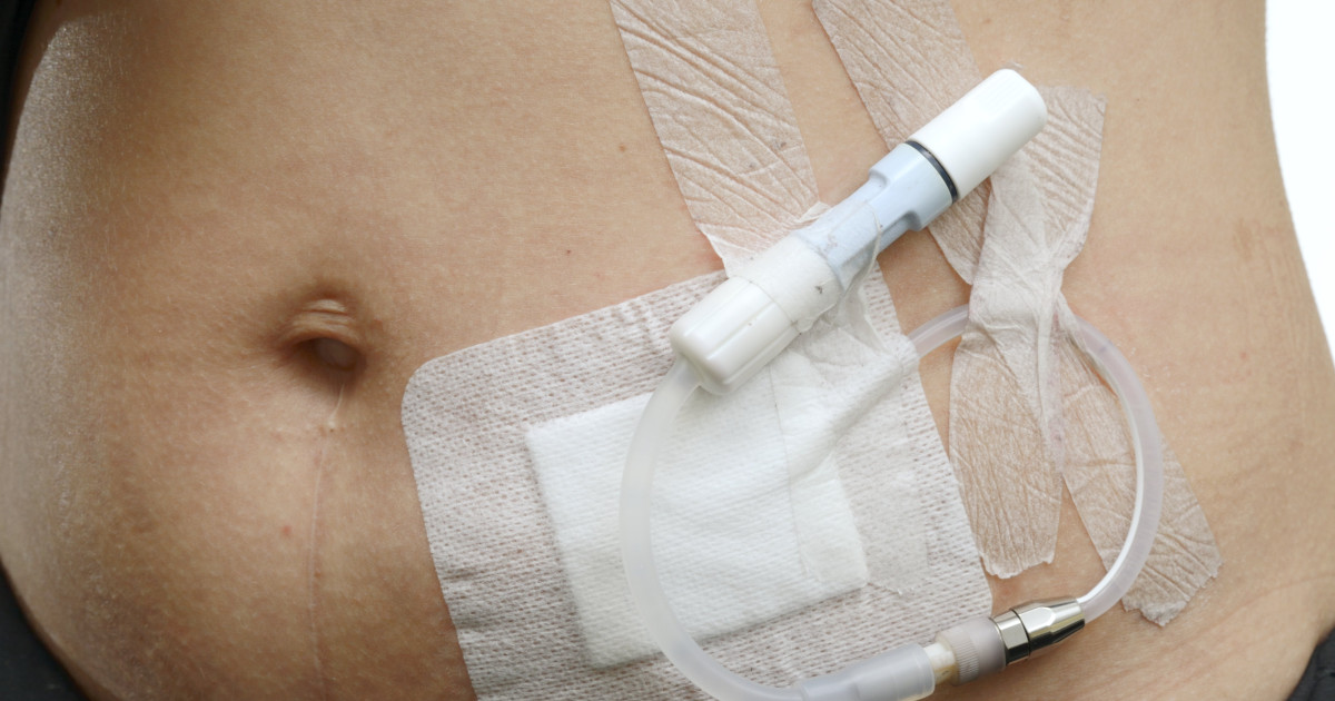 Peritonealt Dialysekateter Ved Nyresvikt En Retrospektiv Studie peritonealt-dialysekateter-ved-nyresvikt-en-retrospektiv-studie