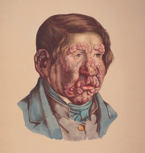 «En 13 Aar gammel Dreng, hos hvem Knuderne ere fuldkommen udviklede, de ere confluerede paa flere Steder, og mange have…