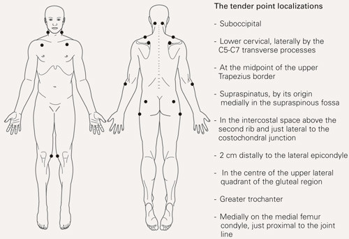 The American College of Rheumatology 1990 diagnostic criteria for fibromyalgia (10). Widespread pain, i.e. pain in at least…