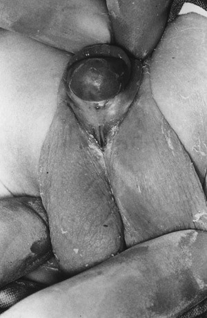 Figure 1  Hypospadias- proximal type (12). Reproduced with permission