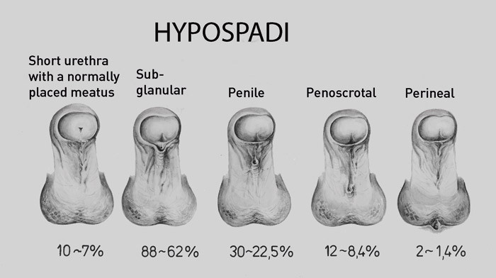 Figure 2  Hypospadias types – percentual distribution (12). Reproduced with permission
