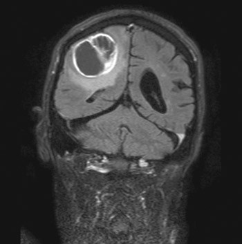Figure 1  MR of the brain showed 4 × 6 × 4 contrast-filled tumour in the right parietal region. Histological examination…