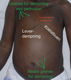 Figur 2  Pasient med en stor leversvulst. Bildet illustrerer hvor man fant dempning ved perkusjon og er et eksempel på…