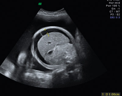 Figur 1  Ultralydbilde, tverrsnitt av føtal abdomen som viser ascites ved hydrops foetalis