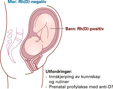 Figur 2  Rh(D)-negativ mor kan immuniseres mot antigenet Rh(D) på fosterets erytrocytter