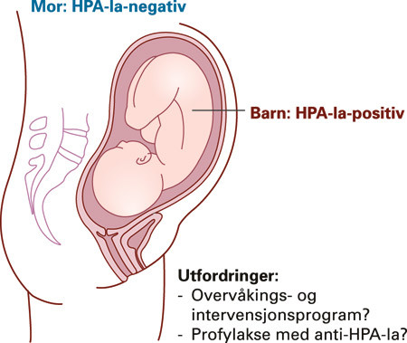 Figur 4  HPA-1a-negativ mor kan immuniseres mot antigenet HPA-1a på fosterets trombocytter