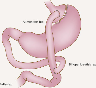 Teknisk utførelse av fedmeoperasjon med laparaskopisk Roux-en Y gastrisk bypass (LRYGBP)