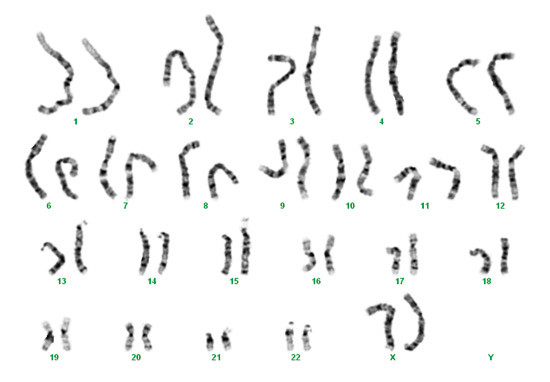 Figur 1  G-bånd-karyotyping (trypsinbehandlede og Giemsa-fargede metafasekromosomer) hos en normal kvinne med karyotype 46,XX