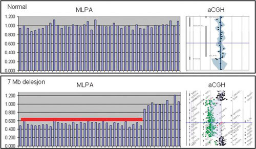 Figur 3  En sammenlikning av resultater fra MLPA-analyse (multipleks ligeringsavhengig probeamplifikasjon) og aCGH-analyse …