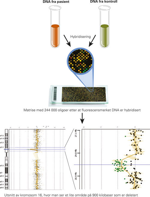 Figur 4  Ved matrisebasert komparativ genomhybridisering (aCGH) renses DNA fra en blod- eller vevsprøve, og etter oppkutting…