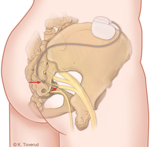 Figure 1: Schematic drawing of a woman’s sacrum and pelvis, posterior view. The nerve electrode has been inserted through…