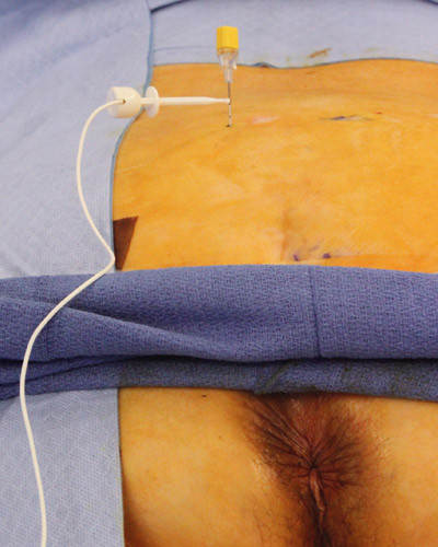 Figure 3: A cannula has been placed in the third sacral foramen on the left side. The cannula is attached to an electrical…