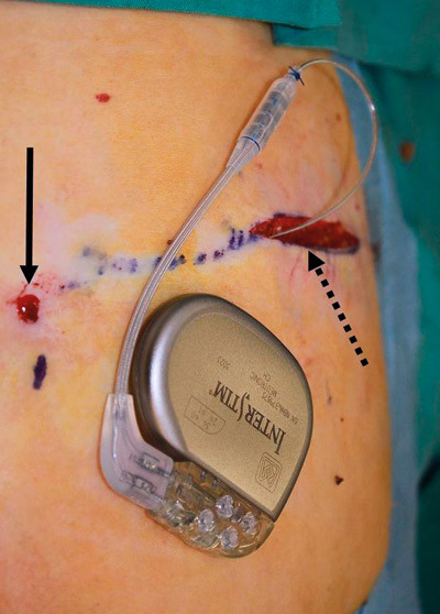 Figure 4: A permanent stimulator attached to an electrode which has been tunnelled subcutaneously from the third sacral…
